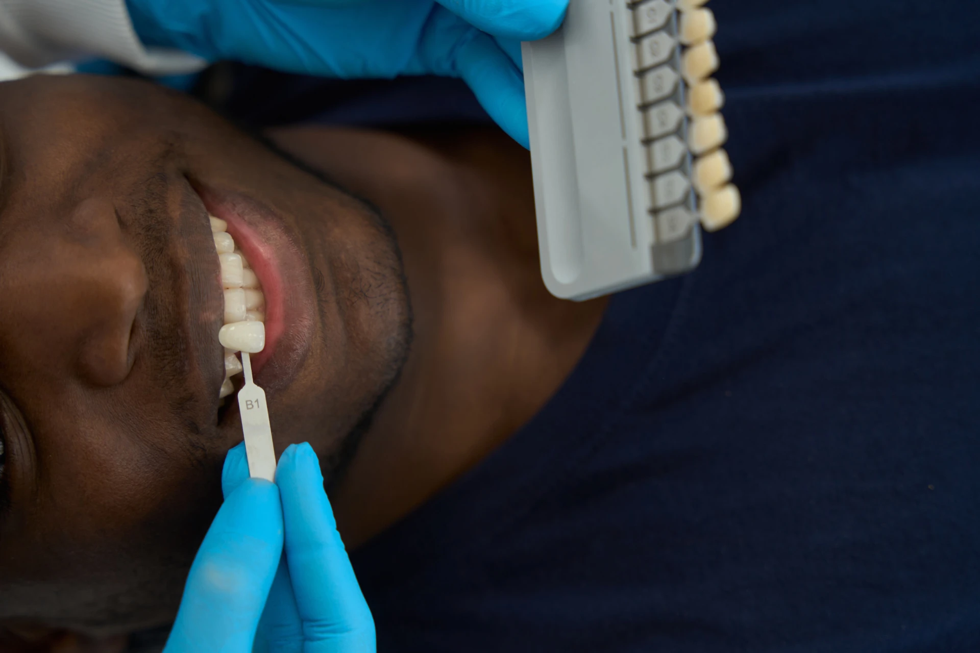 A person undergoing a dental shade matching procedure with a tooth color guide held next to their smile by someone wearing blue gloves, preparing for perfectly matched inlays.