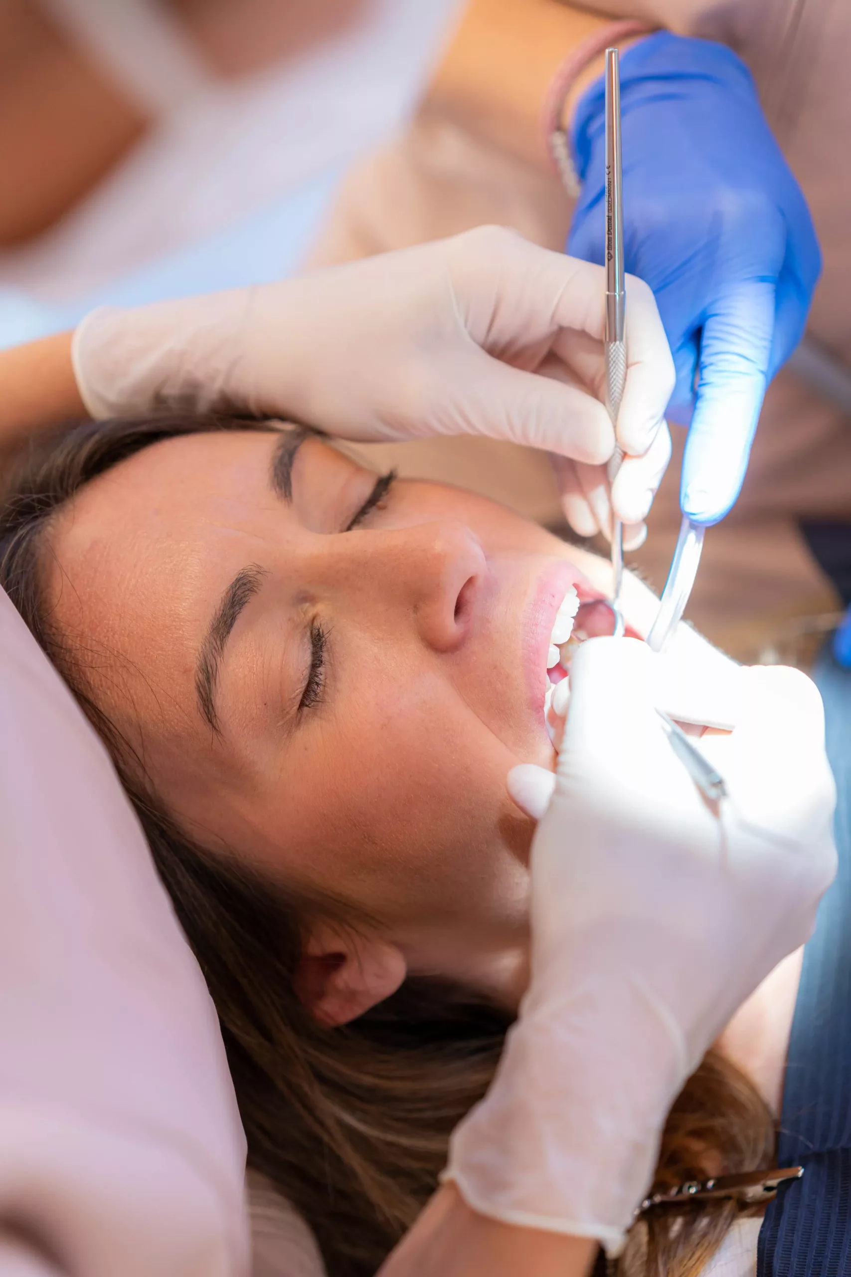 patient-with-the-mouth-open-during-a-dental-exam A dental patient receives treatment as a dentist uses an instrument on their teeth. The patient has their mouth open, eyes closed, and is surrounded by gloved hands under bright lighting.